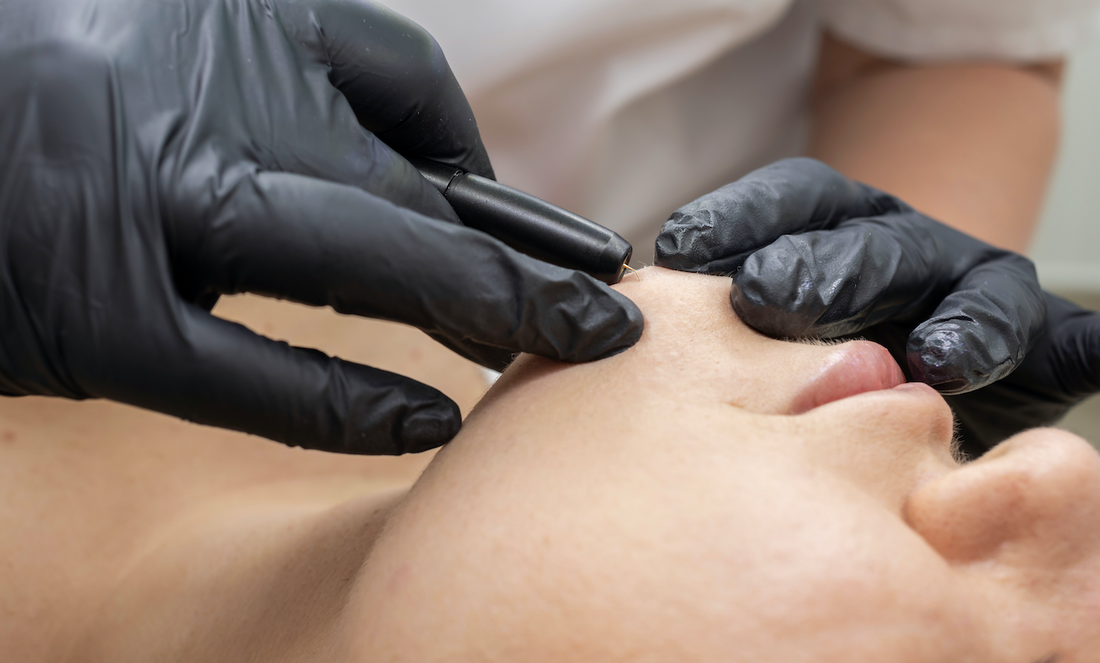 Should You Add Electrolysis? The Business Case for Your Med Spa